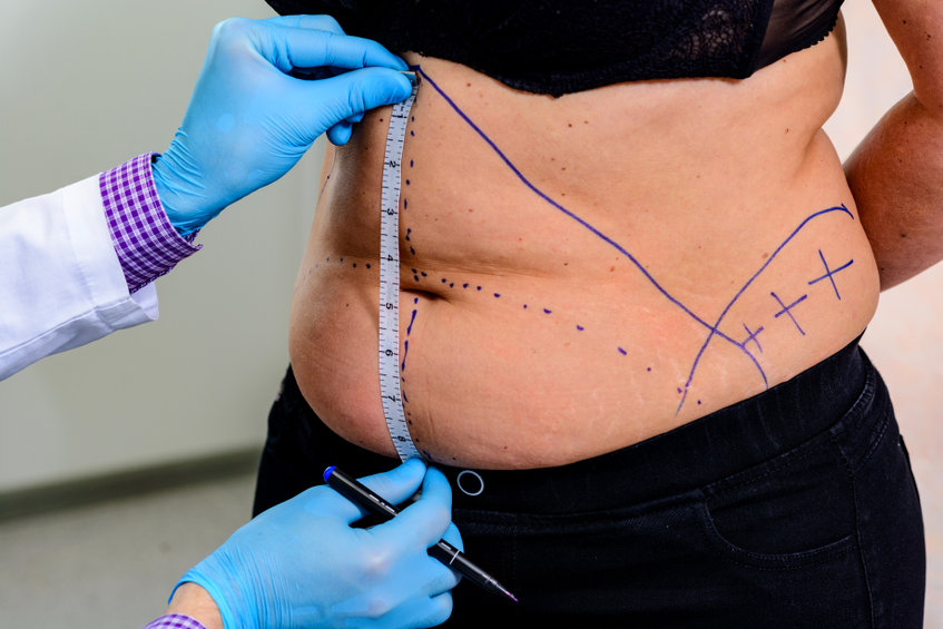 4 Types Of Liposuction: Allow Your Body The Opportunity To Look It’s Best