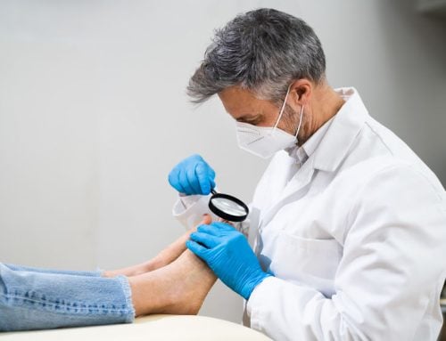 Say Goodbye To Foot Pain: Minimally Invasive Bunion Surgery