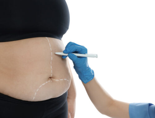 From Tummy Tucks To Liposuction: 3 Tips For Body Contouring